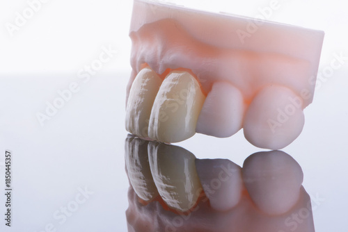 High-quality naturally dental single crowns made of zirconium for fixation to the frontal teeth of upper jaw.