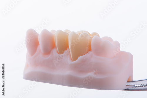 High-quality naturally dental single crowns made of zirconium for fixation to the teeth of upper jaw.