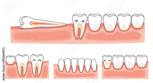 Infographic illustration showing various dental conditions including impacted wisdom tooth and gum issues for oral health education.