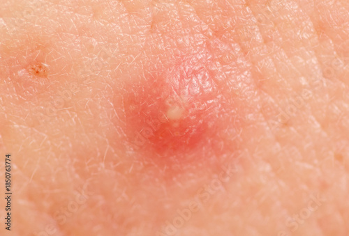 Obraz na plátně Red pimple on a person's face. Close-up