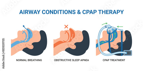 Airway conditions with obstructive sleep apnea and CPAP therapy