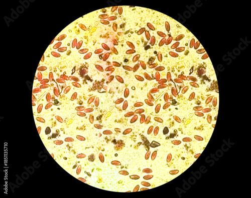 Enterobius vermicularis (EV) pinworm eggs. Parasite in stool specimen under light microscope. 