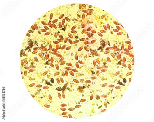 Enterobius vermicularis (EV) pinworm eggs. Parasite in stool specimen under light microscope. 