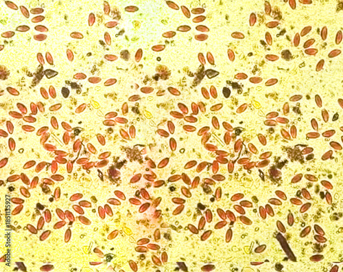 Enterobius vermicularis (EV) pinworm eggs. Parasite in stool specimen under light microscope. 