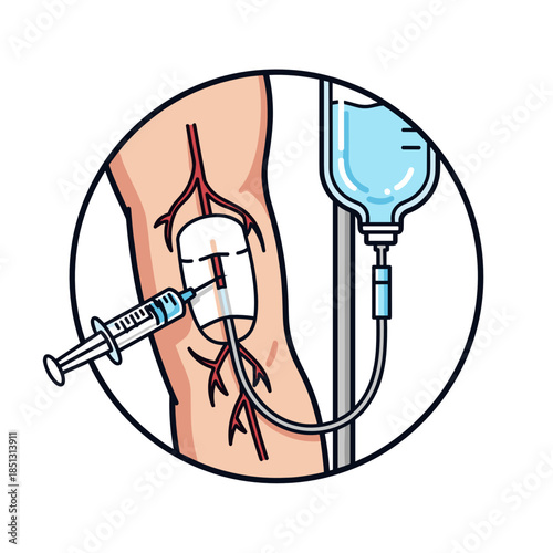 IV injection in arm with syringe and connected drip bag  