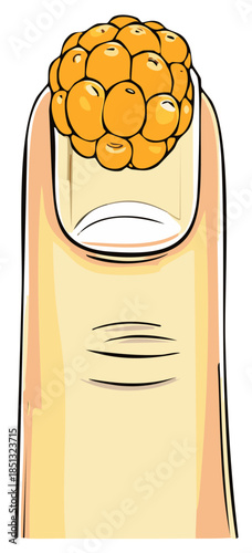 Finger with Wart Cluster Growth Medical Condition Skin Disorder Illustration