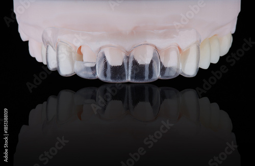 3D printed transparent dental template for gum correction fixed on model on black background.