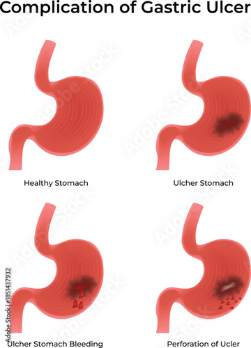 Complications and Progression of Gastric Ulcers diagram Vector illustration