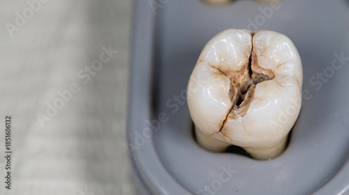 Tooth Fracture from Caries