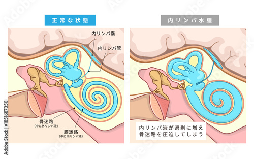 耳の中の中耳、内耳の正常な状態と内リンパ水腫やメニエール症になった時の内リンパ菅の状態