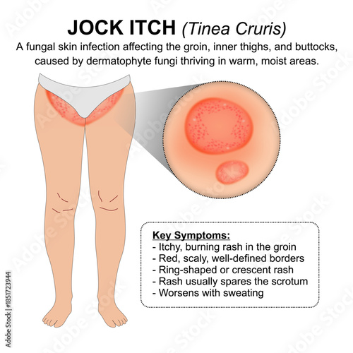 Jock Itch (Tinea Cruris) Medical Skin Flashcard