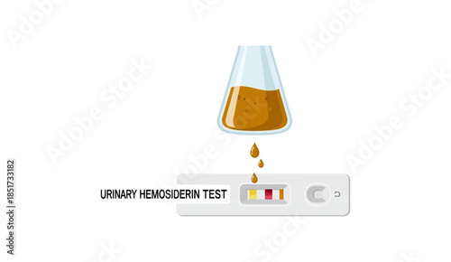 Urinary Hemosiderin Test diagnostic medical illustration.