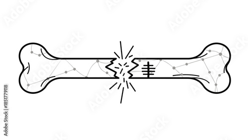 Broken bone illustration with internal structure and fracture lines, representing injury and healing