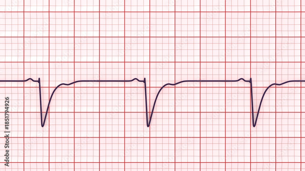 Naklejka premium Left ventricular hypertrophy, 3D illustration showing ECG leads V1-V2 with deep S waves and strain-related ST-T changes.