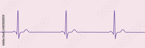 Bild auf Leinwand Sinus bradycardia, 3D illustration