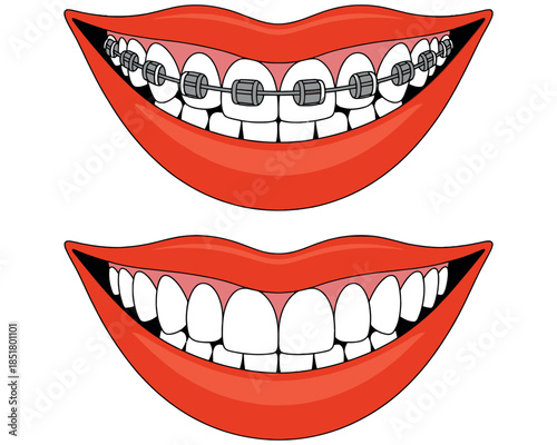 Smiling mouth before and after wearing dental braces for teeth alignment and correction