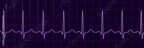 Photos Sinus tachycardia, 3D illustration showing sinus rhythm with shortened RR intervals and increased heart rate