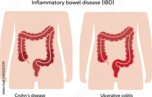Inflammatory Bowel Disease Illustration Showing Crohn’s Disease and Ulcerative Colitis Comparison Human Digestive System Medical Diagram