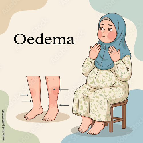 Illustration of Pregnancy Woman With Edema Symptoms Illustrates 