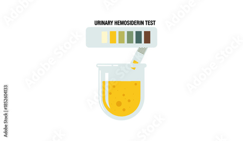 Urinary Hemosiderin Test Diagnostic Medical Illustration