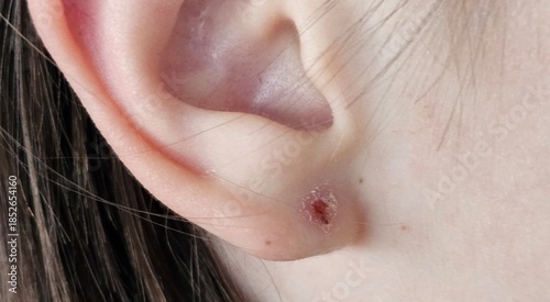 Ear wound lesion herpes zoster and inflammation of the earlobe and inflammation of the ear after puncture purulent wound
