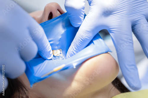 Quadro em tela Close up rubber dam isolation and clamp during pediatric cavity filling procedur