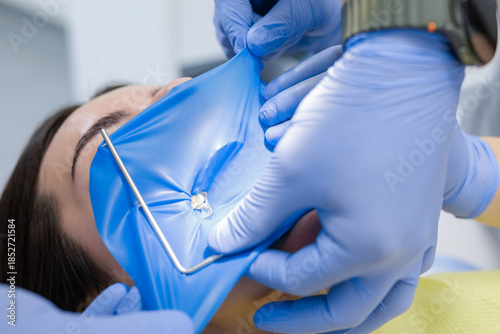 Slika na platnu Rubber dam isolation during pediatric tooth filling procedure in modern dental c