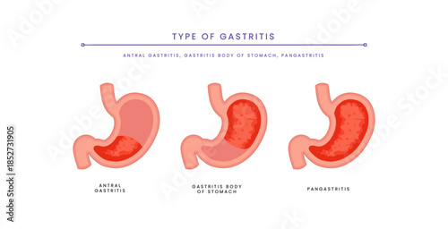 Inflamed Gastritis Stomach Anatomy Illustration. Digestive Disease Diagram for Healthcare