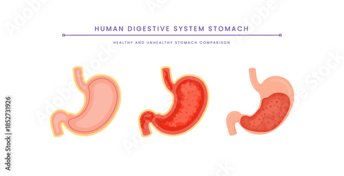 Human Digestive System Stomach. Health and Unhealthy Stomach Comparison.