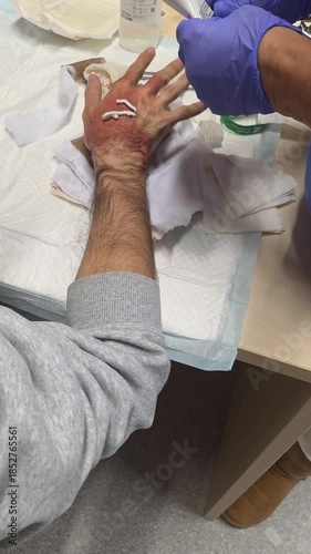 burn treatment and cure at the clinic