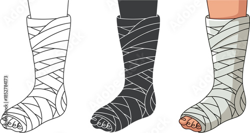 Illustration of a leg in a plaster cast, showcasing line art, silhouette, and fullcolor versions isolated on white background medical concept for fracture recovery