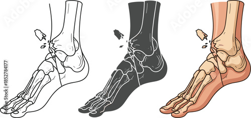 Illustration of a foot with a broken bone isolated on white background the image shows the bones of the foot and ankle, with a fracture in the talus bone