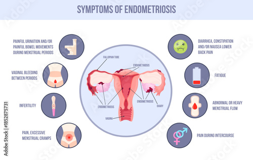Endometriosis symptom. Uterus endometrium period pcos symptoms medical infographic gynecology, female reproductive system womb health polycystic pain, neat vector illustration