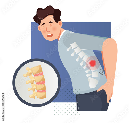 Spine Osteoarthritis - Wear and Tear - Spinal Joints - Stock Illustration