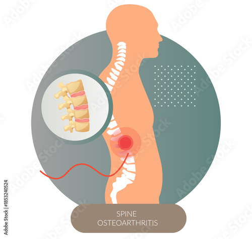 Spine Osteoarthritis - Wear and Tear - Spinal Joints - Stock Illustration