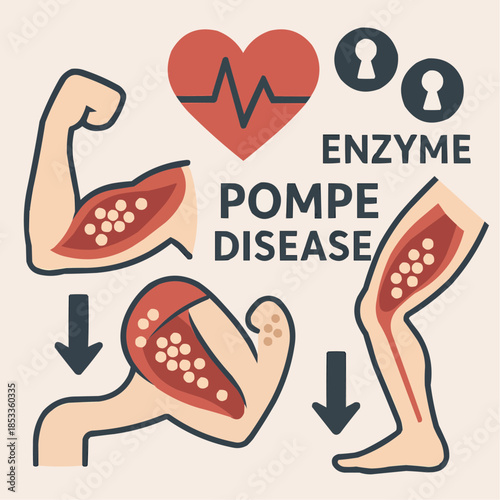 Pompe Disease Muscle Weakness and Enzyme Deficiency Flat Illustration