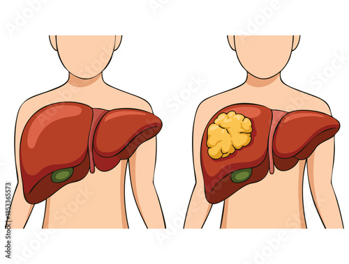 Cancer in human liver on white background illustration medical vector style perfect for health education anatomical graphics disease awareness or study visuals