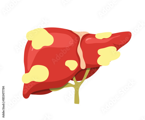 Liver disease. Medical illustration of fatty liver anatomy. Disease treatment for cancer or hepatitis. Vector design.