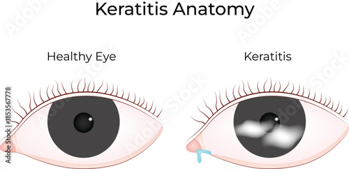 Keratitis Anatomy Healthy Eye vs Affected Eye Comparison Vector Illustration
