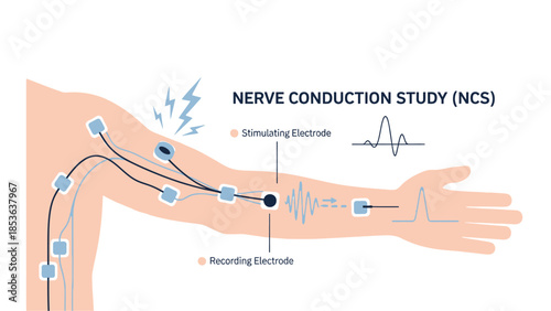 Nerve Conduction Study (NCS) Medical Procedure Infographic