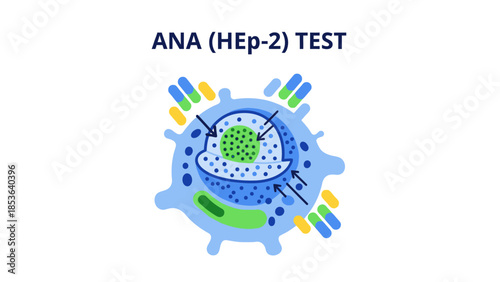 Medical illustration of ANA (HEp-2) test for autoimmune disease diagnosis. Vector style diagram showing a human epithelial cell with antibodies attacking the nucleus.