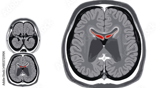 Brain tumor scan illustration in MRI format with detailed views  