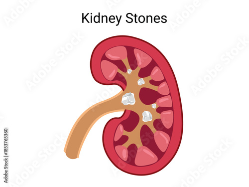 Kidney Stones. Human Kidney anatomy. Vector medical illustration
