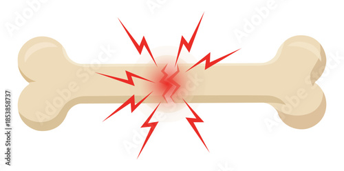 Bone Fracture and Pain A visual representation of a broken bone, depicted with a fracture line and radiating symbols of pain and discomfort, symbolizing a common medical condition.