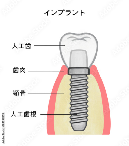 インプラントの構造のイラスト - 1