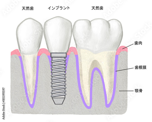 インプラントの歯のイラスト