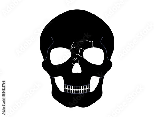 Nasal fracture poster