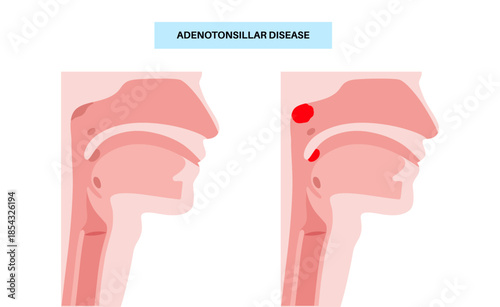 Adenotonsillar disease poster
