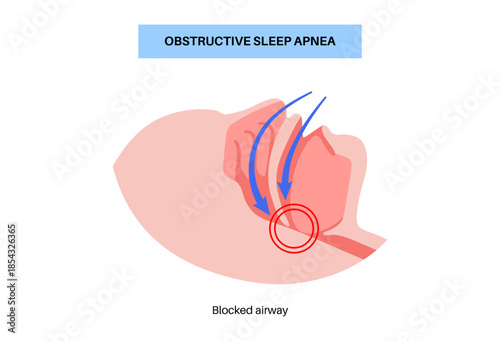 Obstructive sleep apnea