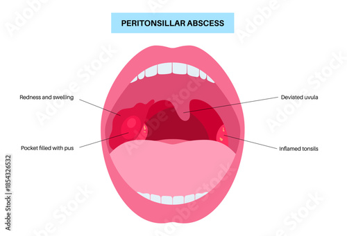 Peritonsillar abscess poster